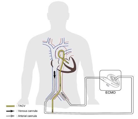 lv vent cannula|venous inflow cannula ecmo.